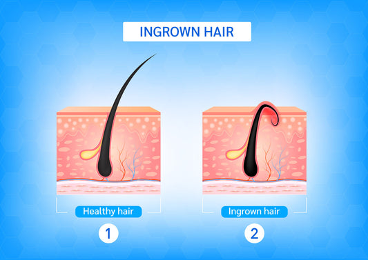 How to Prevent and Treat Ingrown Beard Hairs